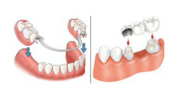 Comparing Bridges, Dentures