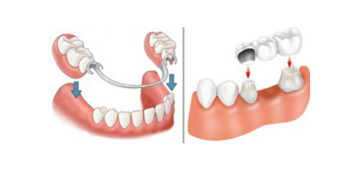 Comparing Bridges, Dentures