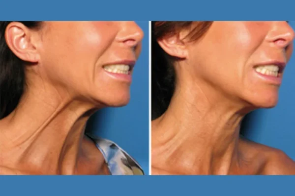 Neck Lifts in Dubai